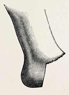 symes amputation, medical equipment, surgical instrument, history of medicine symes amputation, medical equipment, surgical instrument, history of medicine