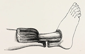 teales amputation of the leo, medical equipment, surgical instrument, history teales amputation of the leo, medical equipment, surgical instrument, history