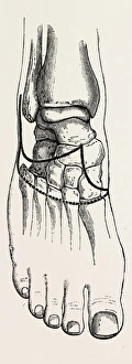 tripiers, medical equipment, surgical instrument, history of medicine tripiers, medical equipment, surgical instrument, history of medicine