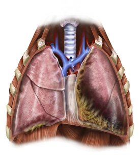 Artist depiction of mesothelioma in the lungs/abdominal cavity Artist depiction of mesothelioma in the lungs/abdominal cavity