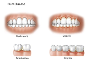 Comparison of healthy gums versus gingivitis Comparison of healthy gums versus gingivitis