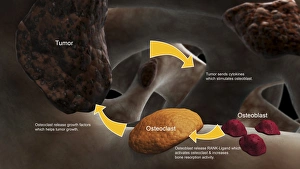 Conceptual image illustrating the process of bone metastasis Conceptual image illustrating the process of bone metastasis
