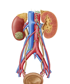 Early stage of kidney cancer with a tumor visible on the kidney Early stage of kidney cancer with a tumor visible on the kidney