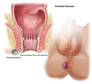 Perianal Abscess Print