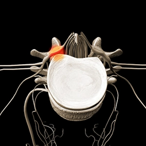 Human Spine Anatomy Prints: A herniated disc pressing against a spinal nerve