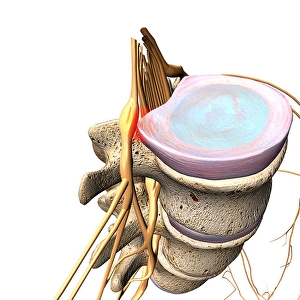 Biomedical Illustration Of Spine Prints: A herniated disc pressing against a spinal nerve