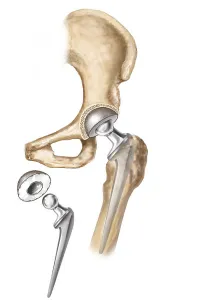 Hip Replacement Surgery Prints: Detail of hip replacemnt