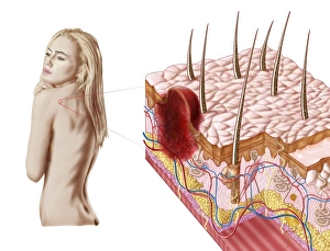 Illustration of an atypical growth on the skin that could be a sign of skin cancer Illustration of an atypical growth on the skin that could be a sign of skin cancer