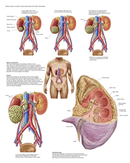 Medical chart showing the signs and symptoms of kidney cancer Medical chart showing the signs and symptoms of kidney cancer