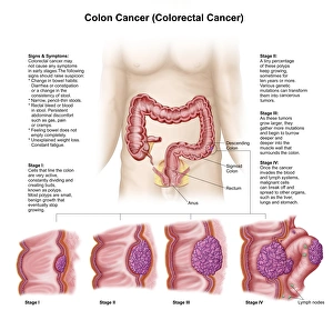 Medical illustration depicting the different stages of colon cancer Medical illustration depicting the different stages of colon cancer