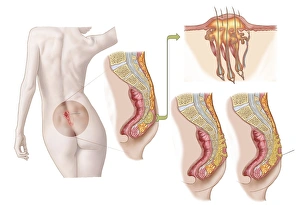 Medical ilustration of a pilonidal cyst near the natal cleft of the buttocks Medical ilustration of a pilonidal cyst near the natal cleft of the buttocks