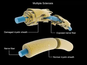 Multiple Sclerosis Neuron Print