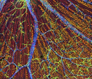 Neurofibromatosis, a genetic disorder of the nervous system Neurofibromatosis, a genetic disorder of the nervous system