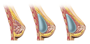 Woman breast implant cross section Woman breast implant cross section