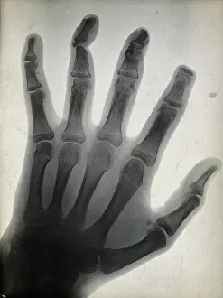 Black And White Medical Images Prints: The bones of a hand, with the tip of the index finger missing, viewed through x-ray, 1896