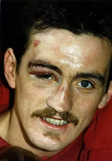 Boxer, Barry McGuigan, shows off his bruises after one of his fights. 1st June 1989 Boxer, Barry McGuigan, shows off his bruises after one of his fights. 1st June 1989
