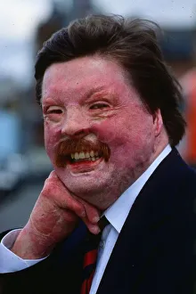 Simon Weston a Falklands War casuality seen here in April 1989 Simon Weston a Falklands War casuality seen here in April 1989