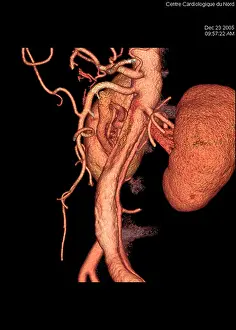Framed Print : Aortic Aneurysm 3D Print