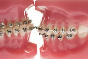 Dental Models Prints: Two models of teeth facing each other in a dentist's office