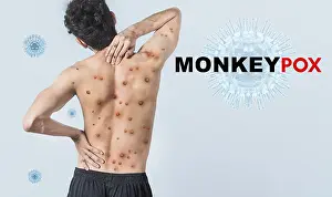 Medical Concept Prints: People with monkeypox on isolated background