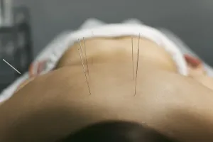 Complementary Health Care Prints: Acupuncture process client