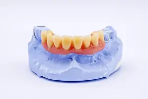 Dentist Treatment Prints: Removable denture of an upper jaw