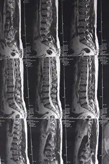 Magnetic Resonance Imaging (MRI) Prints: Slipped disc