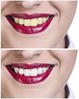 Dental Care Concept Prints: Teeth before and after bleaching treatment