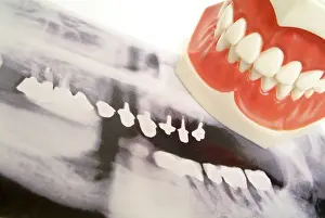 Dentist Treatment Prints: Tooth x-ray