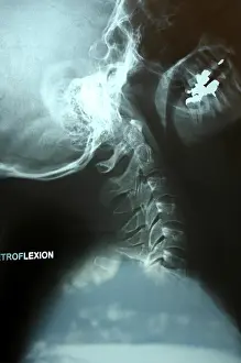 Cervical Vertebrae Prints: X-ray