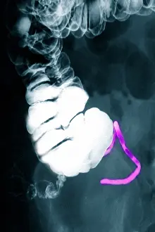 Human Anatomy Images Prints: Appendix x-ray with barium contrast