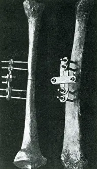 Medical History Prints: Bone Clamp