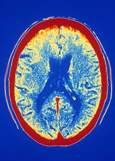 Computed Tomography Scans Prints: Brain, CT Scan