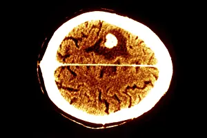 Computed Tomography Scans Prints: Brain edema