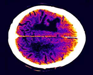 Computed Tomography Scans Prints: Brain edema