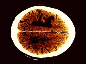 Computed Tomography Scans Prints: Brain edema