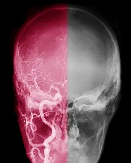 Color-enhanced cerebral angiogram print of a normal right carotid artery