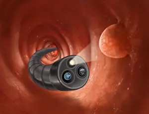 Colonoscopy Print: Polyp in the Colon during Procedure