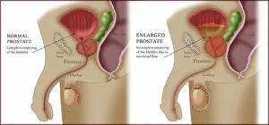 Male Reproductive System Prints: Comparison of Normal and Enlarged Prostate