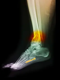 Medical Imaging Techniques Prints: Fractured Ankle