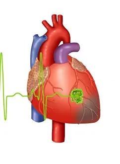 Medical Anatomy Drawing Prints: Heart Attack