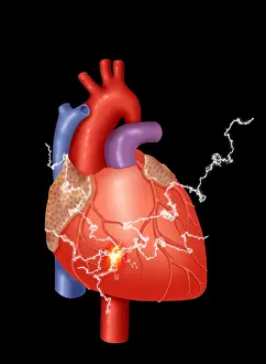 Heart Attack Print: A Conceptual Illustration of Chest Pain