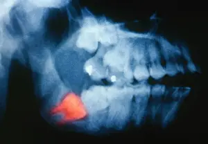 Impacted Wisdom Tooth Print: Color-enhanced X-ray Image