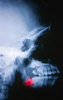 Impacted Wisdom Tooth Print, Color-enhanced X-ray Image