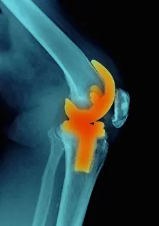 Knee Replacement Print: Colorized X-ray Image