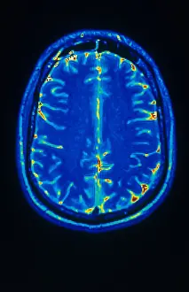 Normal Brain Structure Prints: MRI of Brain