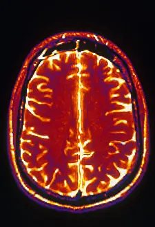 Normal Brain Structure Prints: MRI of Brain