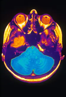 Cerebral Cortex Structure Prints: MRI of Brain