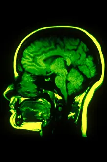 Normal Brain Structure Prints: MRI of Head