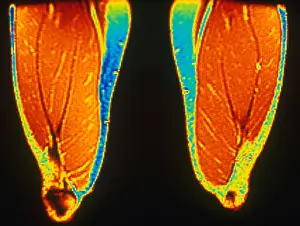 Magnetic Resonance Imaging Prints: MRI of Upper Thighs